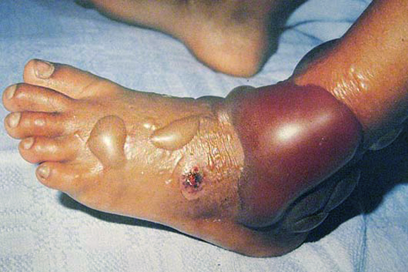 envenomed-foot