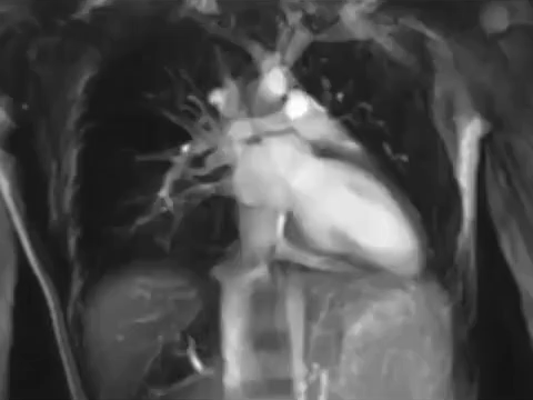 Heart_MRI-1545058697