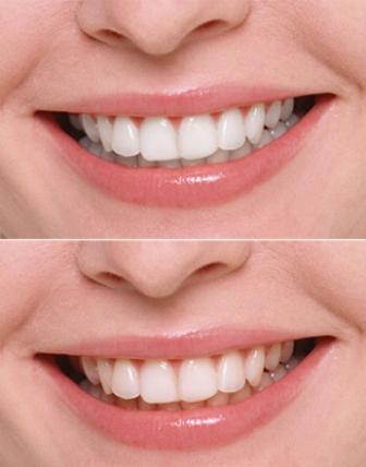 отбеливание зубов