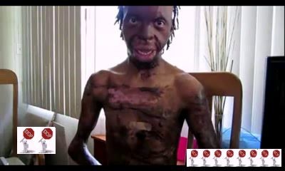 Немного поджарился в детстве ...