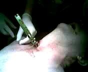 Избыток железа в организме