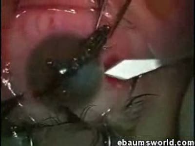 Удаление крюка из глаза