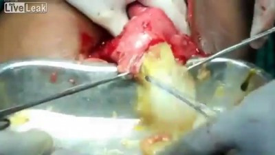 Эхинококкоз ПЕЧЕНИ. не для слабонервных