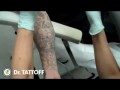 Как с помощью лазера выводят татуировки